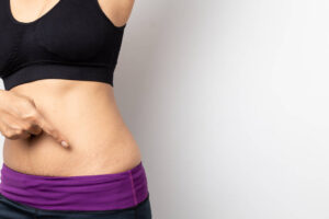 Jak pozbyć się rozstępów – bez specjalistycznych drogich&hellip;